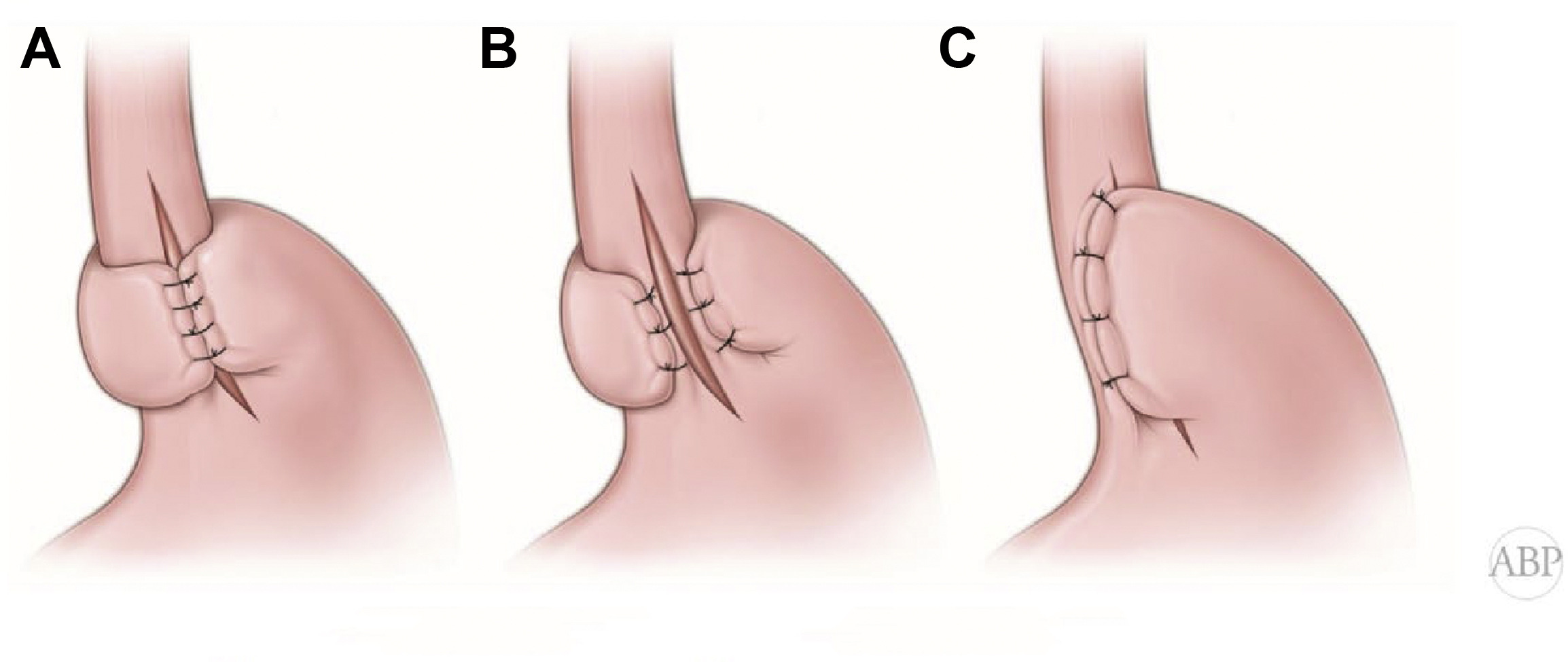 Laparoscopic and robotic surgery for achalasia cardia treatment