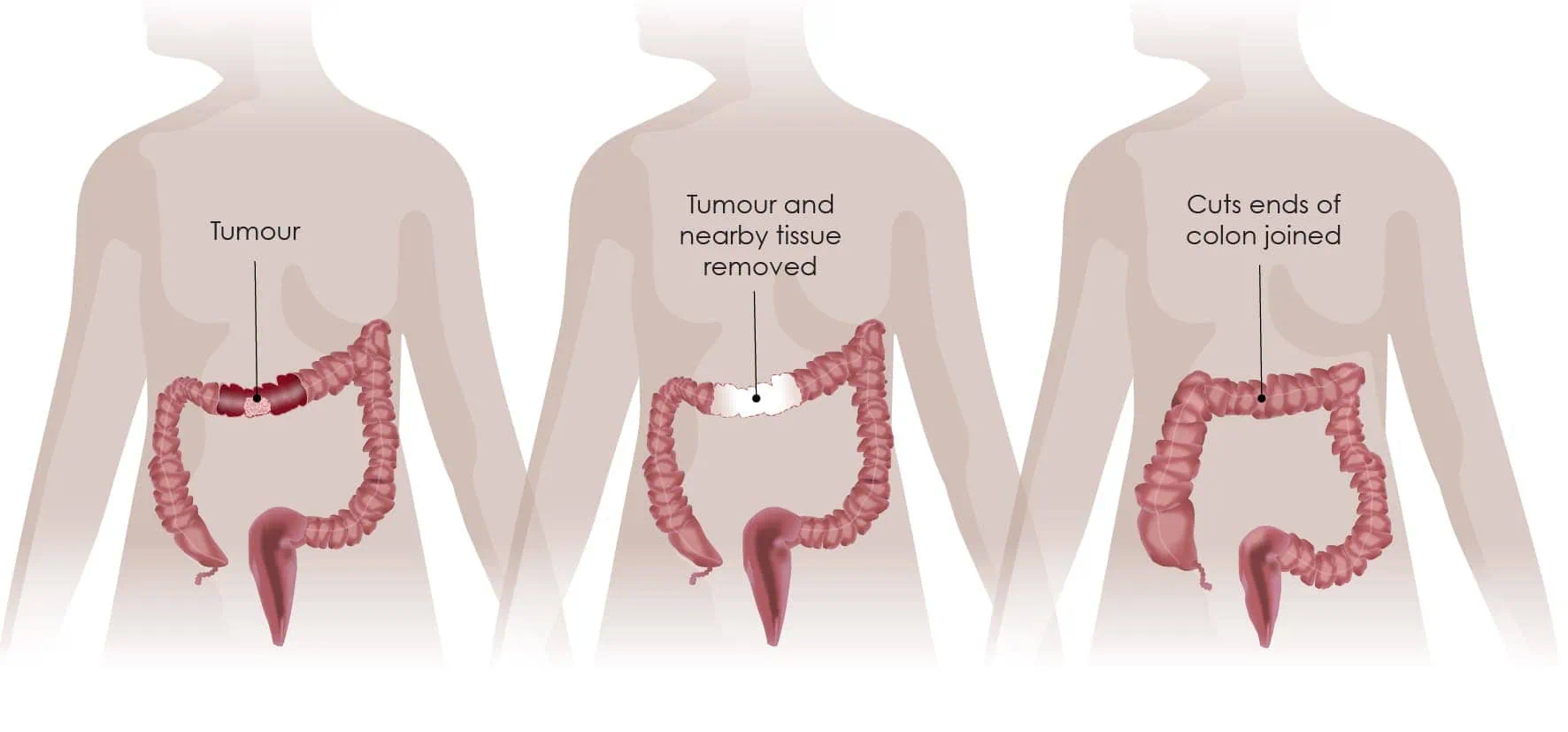 Laparoscopic and robotic colorectal cancer surgery procedure